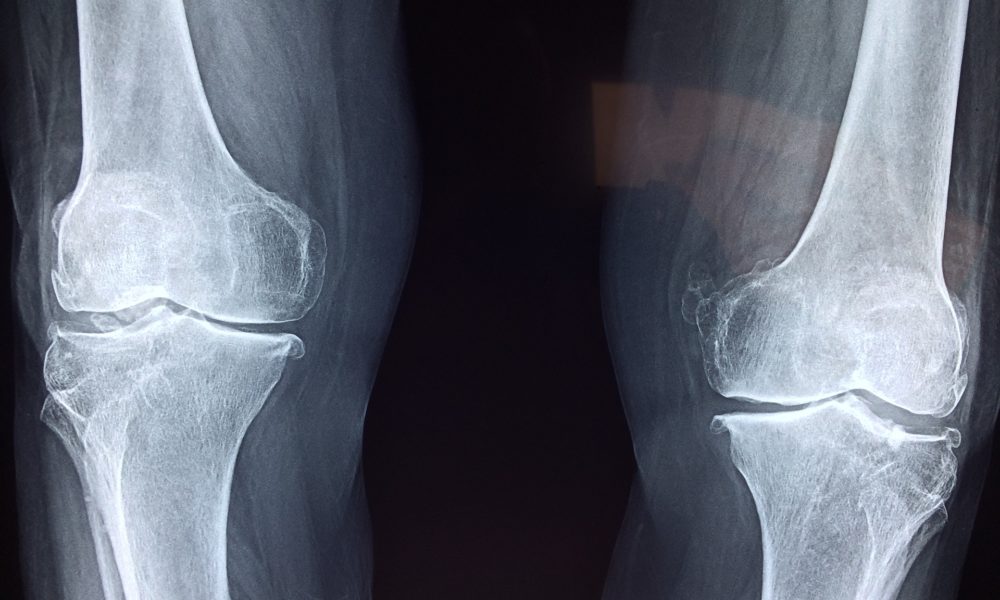 Artroskopia – ratunek dla kolan.